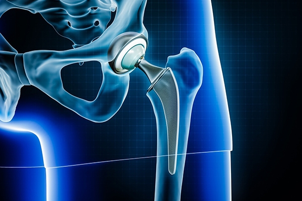 Anterior Approach Hip Replacement in Westchester: Benefits, Recovery & Expert Care