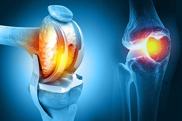 Robotic Hip and Knee Replacement in New York City: Benefits, Procedure & Recovery