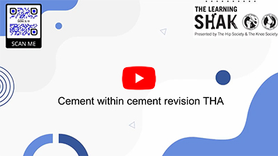 Cement-in-Cement Femoral Revision: Surgical Technique