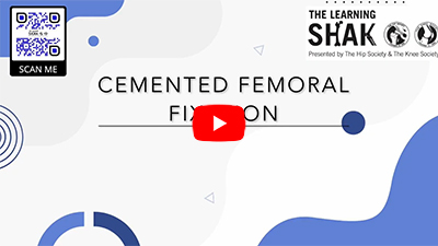 Cemented Femoral Fixation in Hip Replacement Surgery