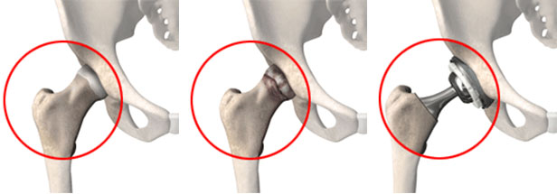 Computer-assisted total hip replacement