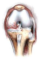 Partial Knee Replacement