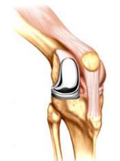 Partial Knee Replacement