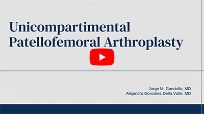 Unicompartimental Patellofemoral Arthroplasty: Surgical Steps Explained
